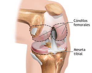 Fractura de rodilla tipos de fracturas Dr Alejandro Pérez Aguilar