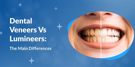 Dental Veneers Vs Lumineers The Main Differences La Dental Clinic