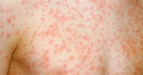 Warnings Issued As One Uk City Faces High Risk Of Measles Outbreak