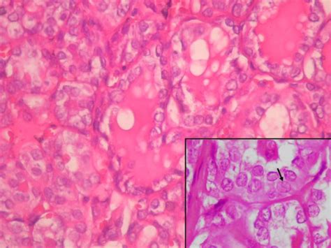 Histologic Section Of The Lesion Follicular Epithelium Cells Have