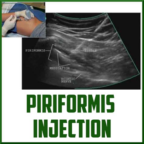 Performing a Piriformis Muscle Injection - My Blog