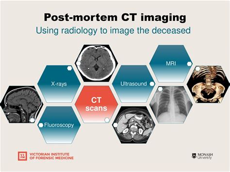 Recent Advances In Forensic Pathology Post Mortem Ct Imaging Ppt