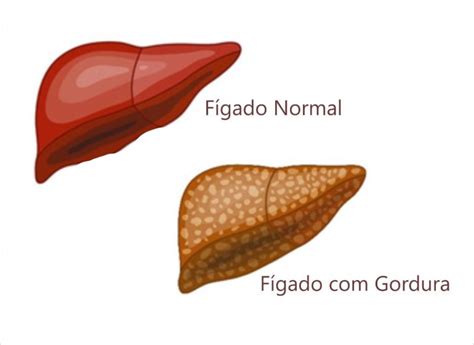 Podcast CBN Como prevenir a esteatose hepática a alimentação