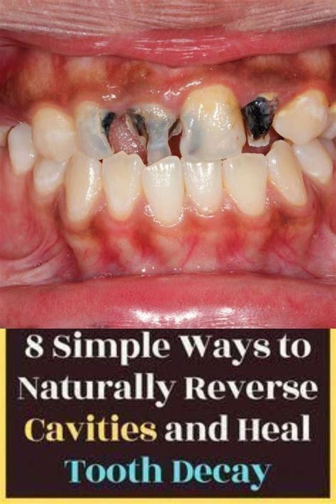 Get Rid Of Cavities And Tooth Decay Brenda Benjamin Artofit