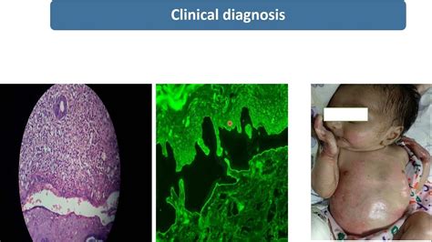 Epidermolysis Bullosa Spot Diagnosis 9 Pediatrics Youtube