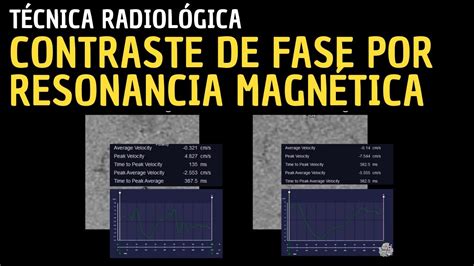 T Cnica Radiol Gica Contraste De Fase Por Resonancia Magn Tica Youtube