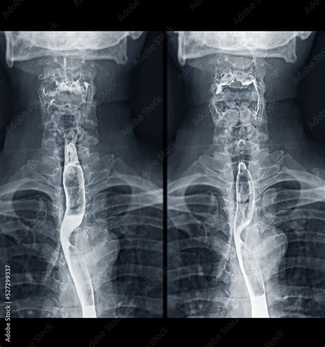 Barium Swallow Study Test Diagnose Barrett S Gi Tract Exam Gerd Ulcers