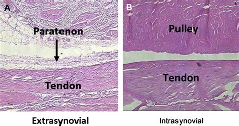 Flexor Tendon Adhesion Formation Hand Clinics