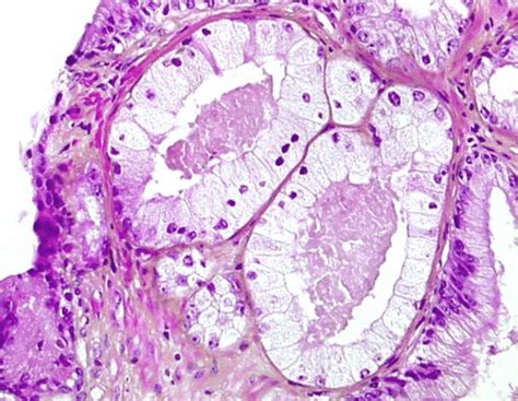 Foamy Gland Prostatic Adenocarcinoma Tumor Cells With Abundant Foamy Download Scientific