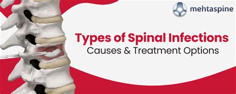 How Serious An Infection In The Spine Can Be Mehta Spine