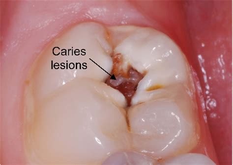 Dental Cavity Molar