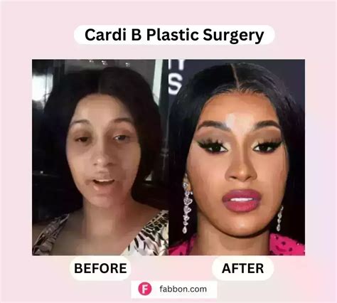 Cardi B Plastic Surgery Full Guide Before And After Photos Fabbon