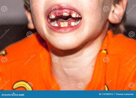 Close-up of Child of Eight Years with the Problem of Not Loosing His ...