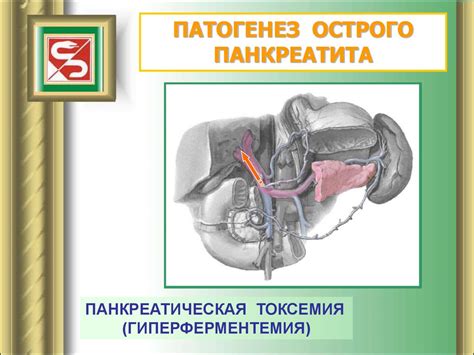 Острый панкреатит - презентация онлайн