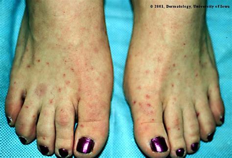 Enterovirus Foot Rash Picture From Ui Dermatology Hardin Md