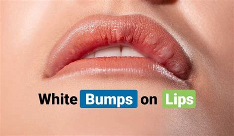 Factors That Cause Tiny White Bumps On Lips Healthy Active