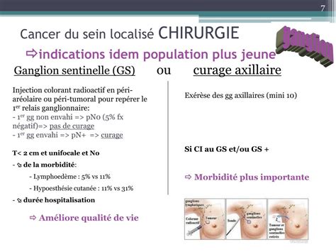 Ppt Spécificités De La Prise En Charge Du Cancer Du Sein Après Lâge