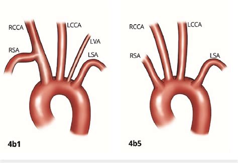 Subgroups Of Branching That Originate From The Aortic Arch As Four Download Scientific Diagram