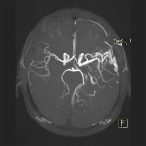 Cerebral Arteriovenous Malformation Image Radiopaedia Org