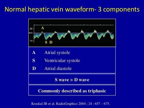 Hepatic Vein Normal Wave Form Portal System Echocardiogram Medical Ultrasound