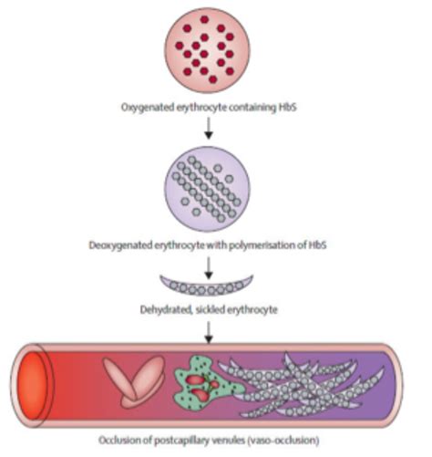 Biomechanics Of Sickle Cell Disease