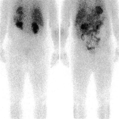 A 99m Tc Hmdp Anterior Ant And Posterior Post Total Body Bone