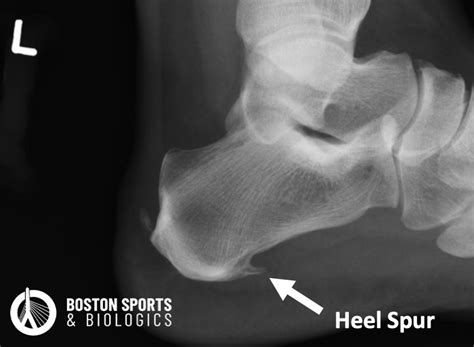 heel spur  ray