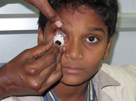 Prosthetic Eye Definition Of Prosthetic Eye