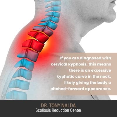 Cervical Kyphosis: What Is The Best Treatment For Kyphosis?