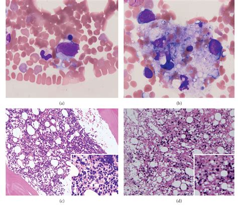 Figure From Hemophagocytic Syndrome Associated Variant Of