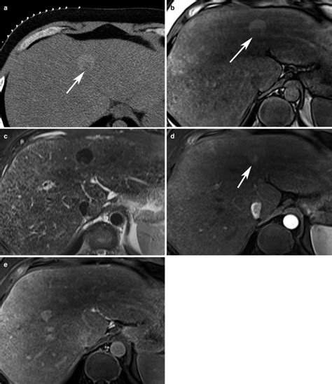 Fig Hcc With Nodule In Nodule Appearance A Diseases