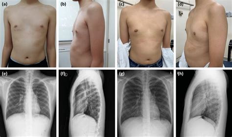 Evaluation Of Treatment Outcomes After Year Of Vacuum Bell Vb