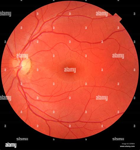 Simple Anatomy Of The Retina By Helga Kolb Webvision 54 Off