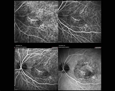 Angiograf A Con Verde De Indocianina Retina Y M Cula Consultores