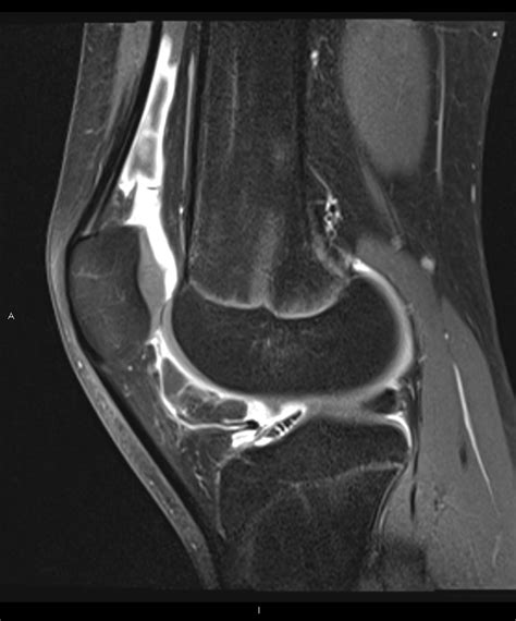 Juvenile Idiopathic Arthritis Image