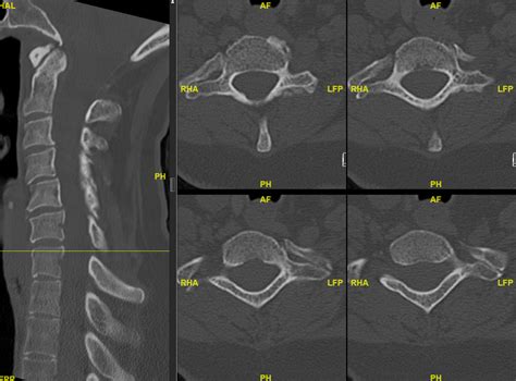 Cervical Rib And Tos