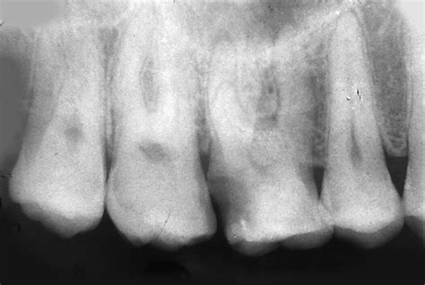 Preoperative Intraoral Periapical Radiograph Of Showing Distal