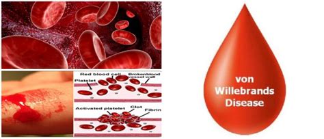 Von Willebrand's disease: Types, Causes, Symptoms, Diagnosis, Treatment, and Prevention - Hoool ...