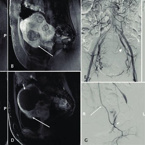 Case 3 A Pre Embolization Sagittal Post Gadolinium MRI Depicting