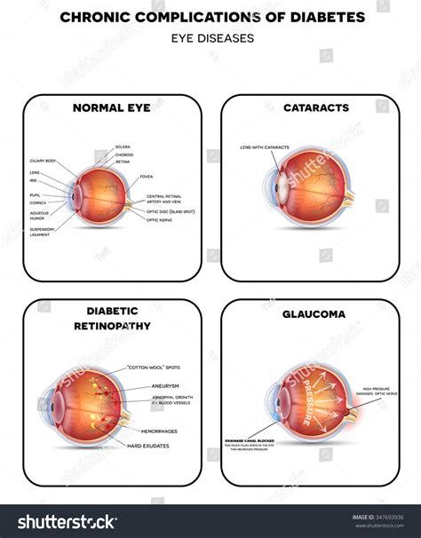 Diabetic Vision Diseases Retinopathy Cataract And Glaucoma Also Healthy Eye Detailed Anatomy