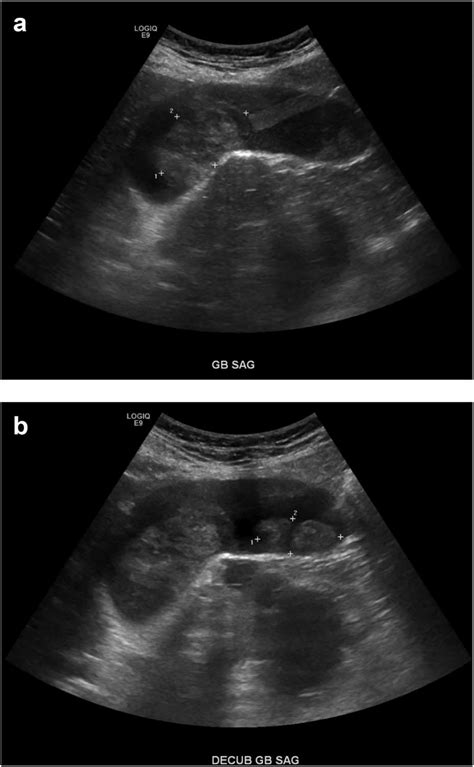 Right Upper Quadrant Ultrasound