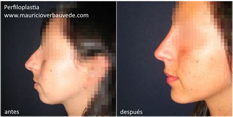 Perfilopl Stia Nariz Expertos En Cirug A Pl Stica Facial