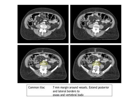 Radiotherapy Planning In Carcinoma Cervix Dr Rekha