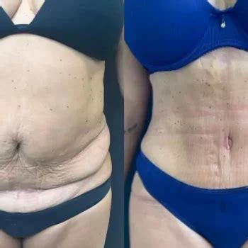 Lipoabdominoplastia Cirug A Plastica Doctor Pablo Panzeri