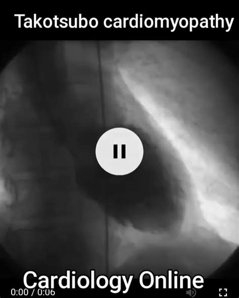 Atypical Takotsubo Cardiomyopathy YouTube