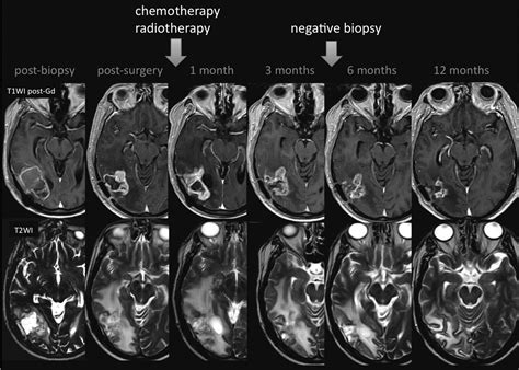 Pseudoprogression And Pseudoresponse Imaging Challenges In The