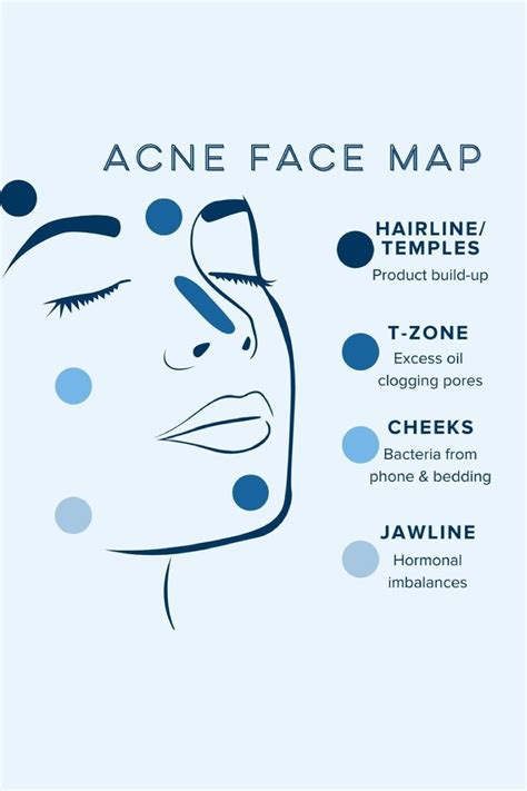 Acne Face Map Face Mapping Acne Face Acne Face Mapping