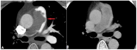 Diagnostics Free Full Text Ct Imaging Findings Of Pulmonary Artery Stenosis A Pictorial Review