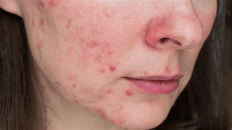 Papulopustular Rosacea Symptoms And Treatments Gladskin