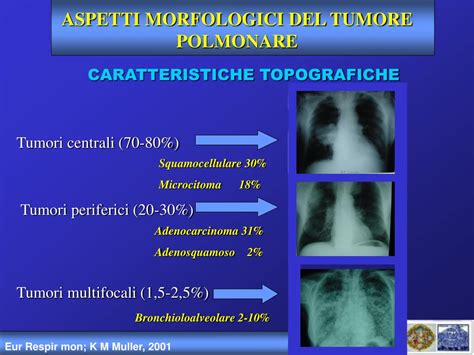 Ppt Diagnosi E Stadiazione Del Tumore Polmonare Powerpoint